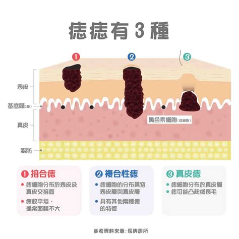 陰莖長痣|痣形成的原因？痣長毛、痣變多變大是痣病變？5招判別